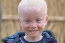 Сегодня — Международный день распространения информации об альбинизме: редчайшие люди планеты без окраса