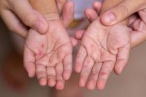 В Монголии подтверждено более 500 случаев заражения корью