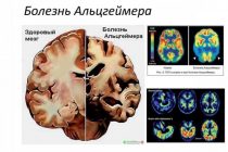 Новое исследование дает возможность выявить болезнь Альцгеймера с точностью до 92-х процентов