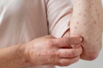 В 2025 году в США зарегистрировано более 2000 случаев кори, что стало максимумом с 1992 года