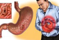 МАСЛИҲАТИ МУТАХАССИС. Истеъмоли хӯроки вазнин боиси авҷи бемории гастрит мегардад