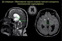Дар Тоҷикистон ҷарроҳии мураккаби мағзи сар гузаронида шуд