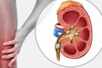МАСЛИҲАТИ МУТАХАССИС. Бемории санги гурда дар фасли зимистон авҷ мегирад